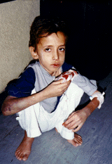 11 year old child with hemophilia..no coagulants available. Qadissiya Hospital (outskirts of Baghdad). (Photo: Rick McDowell 