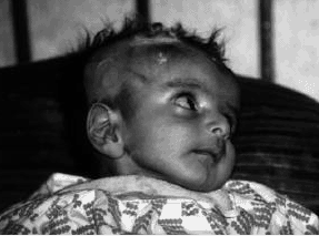 Child with Leukemia 1997