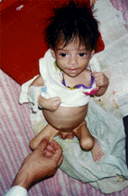 A lovely child suffering from nutritional Marsmus unware of his grim fate. Basra Paediatric and Gynecology hopsital. (Photo: Rick McDowell ) 