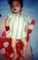 Yousif Assad suffering from Septicemia (a lethal infection of the blood). Parents sold most of their belongings to secure the medicine, but is still not enough to save him. Qadissiya Hospital (outskirts of Baghdad) 