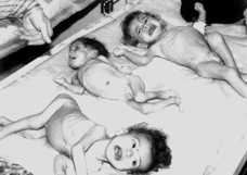 Three brothers all suffering severe malnutrition 